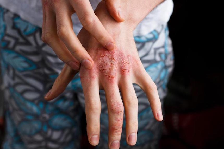 natural-remedies-for-atopic-dermatitis-and-allergic-contact-dermatitis