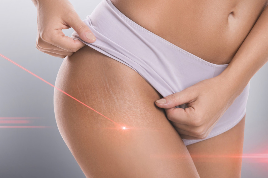 more-than-hair-removal-blemishes-you-can-beat-with-laser-treatment